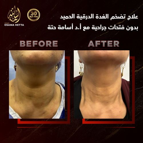 علاج تضخم الغدة الدرقية الحميد